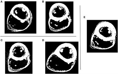 Left Ventricular Trabeculations Decrease the Wall Shear Stress and Increase the Intra-Ventricular Pressure Drop in CFD Simulations